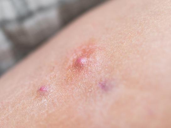 Hidradenitis suppurativa