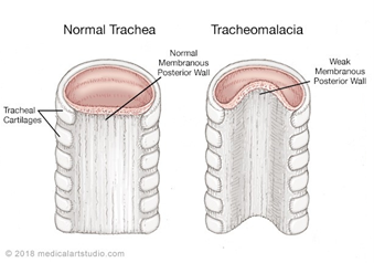 tracheomalacie